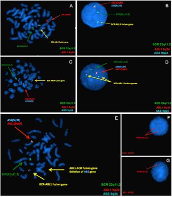 Genomic Copy Number Variants in CML Patients With the Philadelphia Chromosome (Ph+): An Update